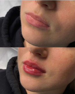 Модель на увеличение губ